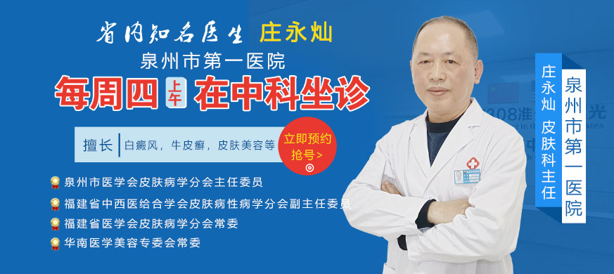 特邀白癜风专家庄永灿