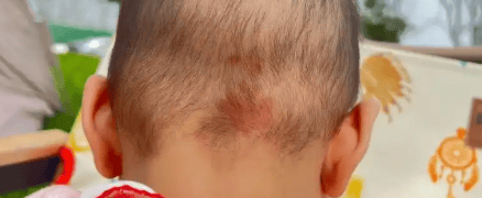 胎记到底要不要管？这两种出生自带的“印记”通常可以放心！