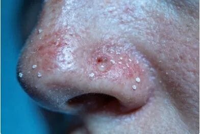 脸越洗越油，痘痘反复长？点击了解脂溢性皮炎的科学护理“避坑”指南。