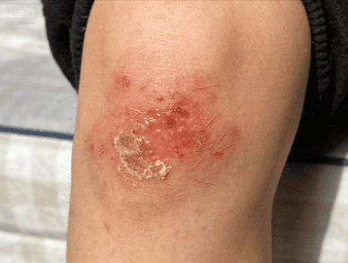 身上总是莫名发痒，还起红疹？是湿疹、体癣还是皮肤干燥？福建泉州中科皮肤医院在线为您解析