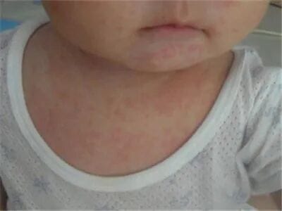 孩子皮肤反复瘙痒、睡不安稳?福建泉州中科皮肤医院带您科学认识特应性皮炎与日常管理要点 孩子皮肤反复瘙痒、睡不安稳?福建泉州中科皮肤医院带您科学认识特应性皮炎与日常管理要点