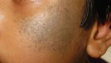 宝宝出生自带“草莓红包”要紧吗？泉州中科皮肤医院教你分清血管瘤与鲜红斑痣，点击在线咨询