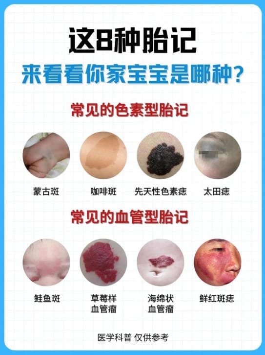 宝宝出生就有胎记，要不要处理？家长最关心的几个问题一次说清