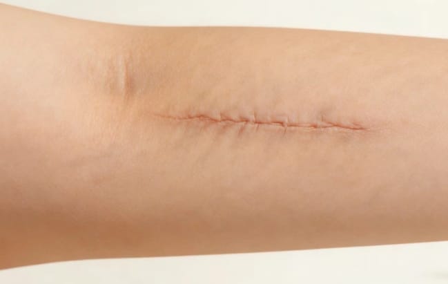 遮挡疤痕只是一时，稳定状态才是关键！福建省泉州中科皮肤医院为您解析