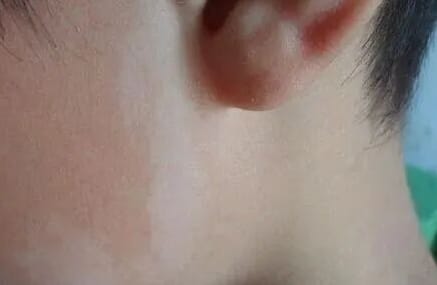 宝宝出生自带“草莓红包”要紧吗？泉州中科皮肤医院教你分清血管瘤与鲜红斑痣，点击在线咨询