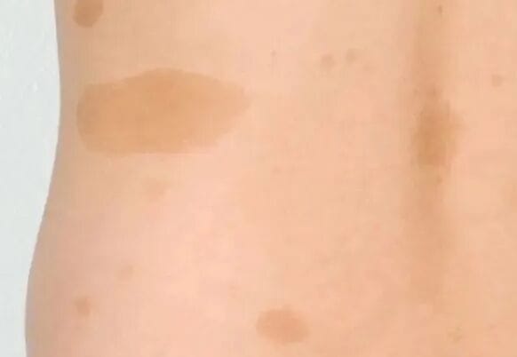 宝宝出生自带“草莓红包”要紧吗？泉州中科皮肤医院教你分清血管瘤与鲜红斑痣，点击在线咨询