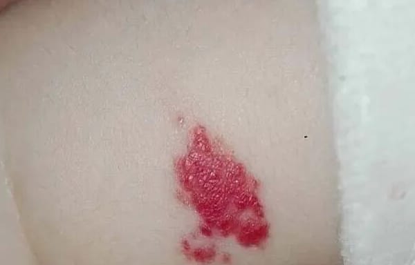 宝宝出生自带“草莓红包”要紧吗？泉州中科皮肤医院教你分清血管瘤与鲜红斑痣，点击在线咨询