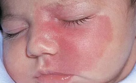 宝宝出生自带“草莓红包”要紧吗？泉州中科皮肤医院教你分清血管瘤与鲜红斑痣，点击在线咨询