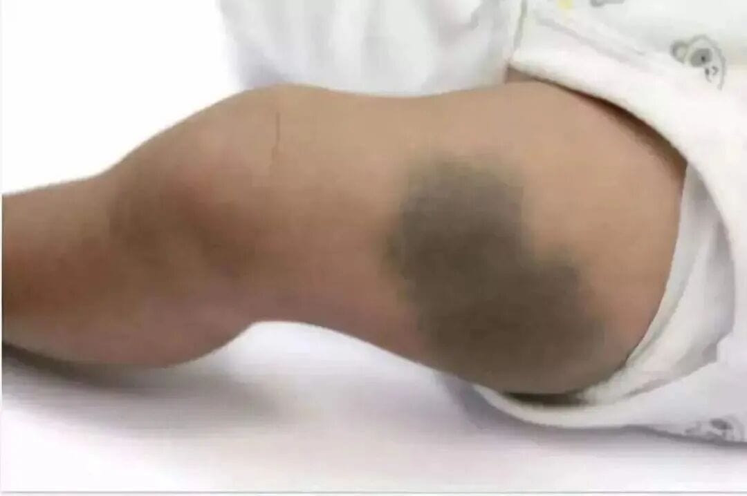 胎记到底要不要管？这两种出生自带的“印记”通常可以放心！