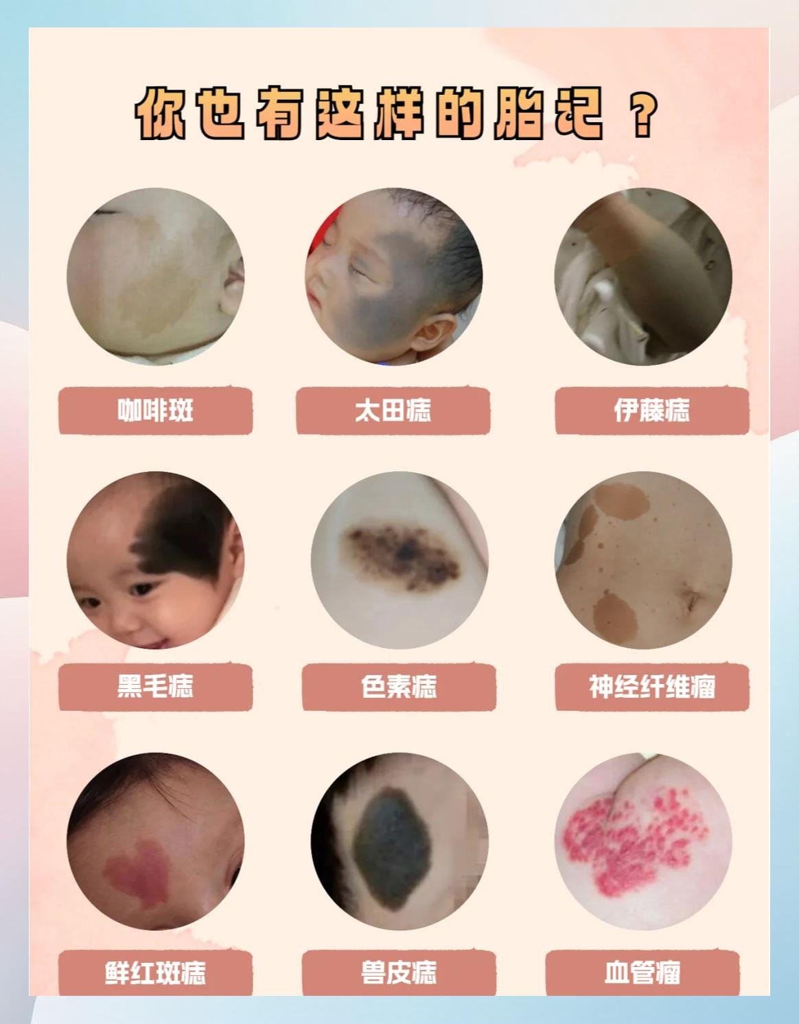 孩子出生就有红色胎记，是鲜红斑痣还是血管瘤？福建泉州中科皮肤医院帮你分清