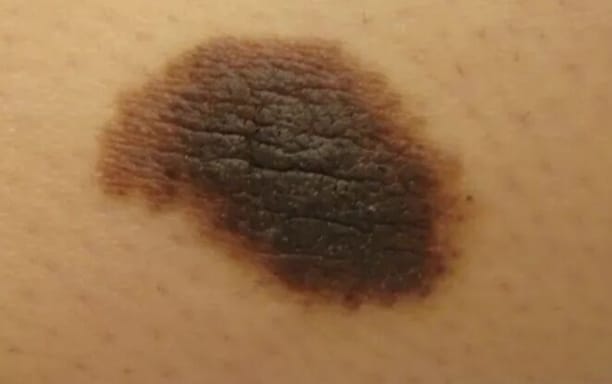 宝宝出生自带“草莓红包”要紧吗？泉州中科皮肤医院教你分清血管瘤与鲜红斑痣，点击在线咨询