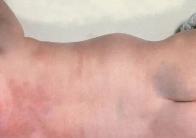 宝宝出生自带“草莓红包”要紧吗？泉州中科皮肤医院教你分清血管瘤与鲜红斑痣，点击在线咨询