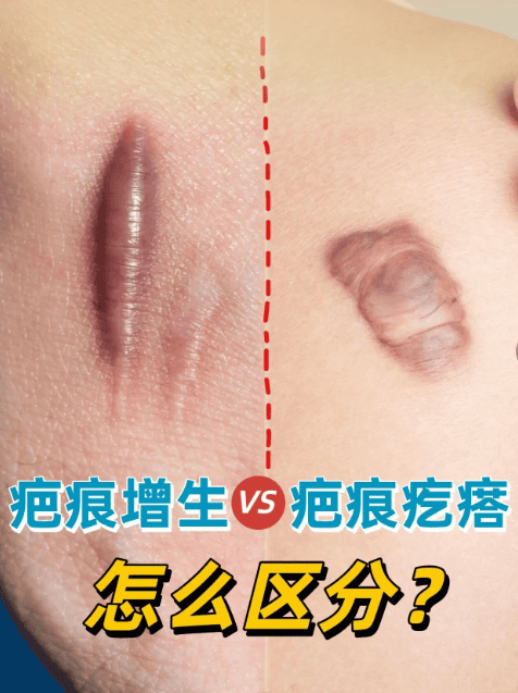 增生性疤痕和疤痕疙瘩如何区分？泉州中科疤痕医院专业指导，避免修复误区！