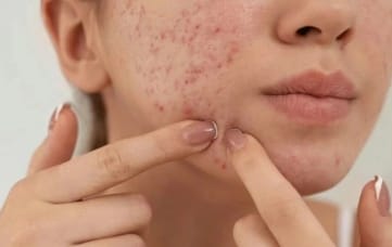 痤疮好了却留印?炎症控制是关键!来听福建省泉州中科皮肤医院的护理建议 痤疮好了却留印?炎症控制是关键!来听福建省泉州中科皮肤医院的护理建议