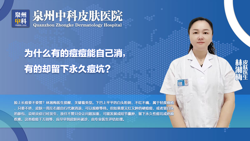 福建泉州中科皮肤医院林湘梅医生科普：脸上长痘不管它能自己好？这几种情况千万别等！