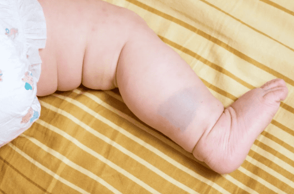 家长注意！孩子身上的太田痣颜色加深、快速隆起怎么办？点击咨询泉州中科胎记医院医生