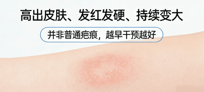 福建泉州中科疤痕医院:伤口愈合后出现硬块,是不是疤痕体质?医生教你这样判断 福建泉州中科疤痕医院:伤口愈合后出现硬块,是不是疤痕体质?医生教你这样判断