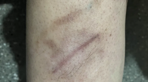 陈旧手术疤痕又痒又凸，反复困扰？福建泉州中科为你分析疤痕类型与方案