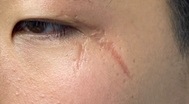 陈旧手术疤痕又痒又凸，反复困扰？福建泉州中科为你分析疤痕类型与方案