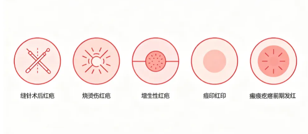 福建泉州红色疤痕反复增生？中科瘢痕医院庄永灿主任详解去红染料激光修复方案